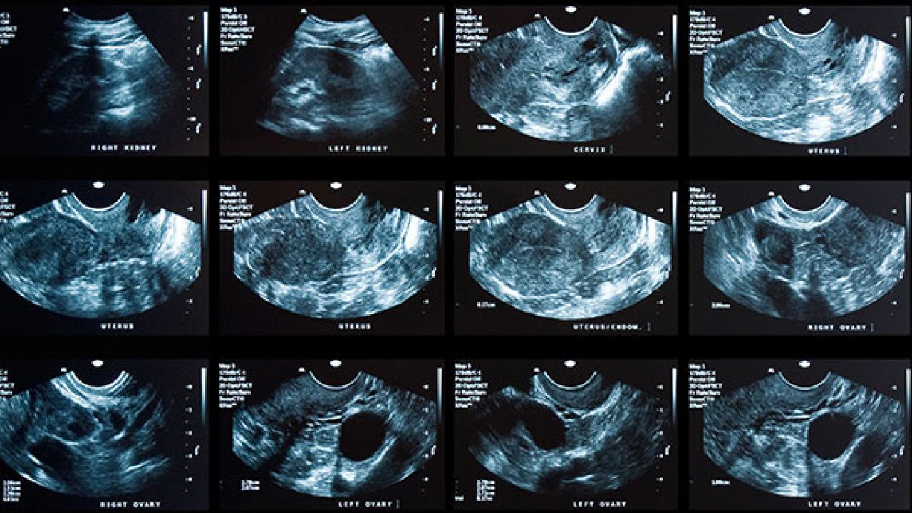 porque se producen los polipos uterinos