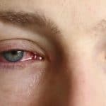 conjuntivitis