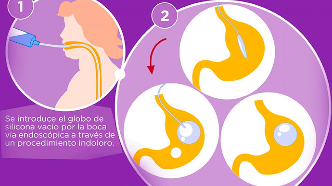 En que consiste la dieta liquida preoperatoria
