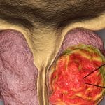 síntomas de cáncer de próstata