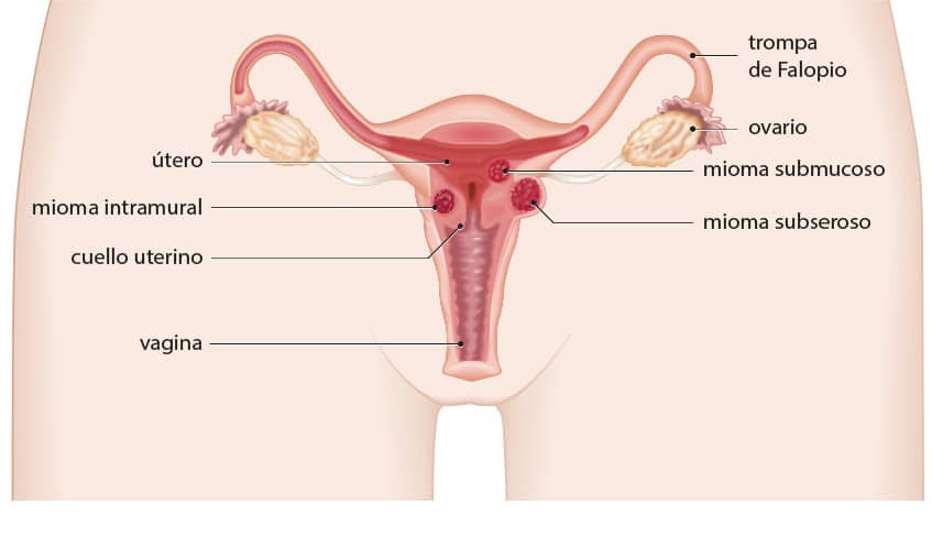 Miomas uterinos en el útero