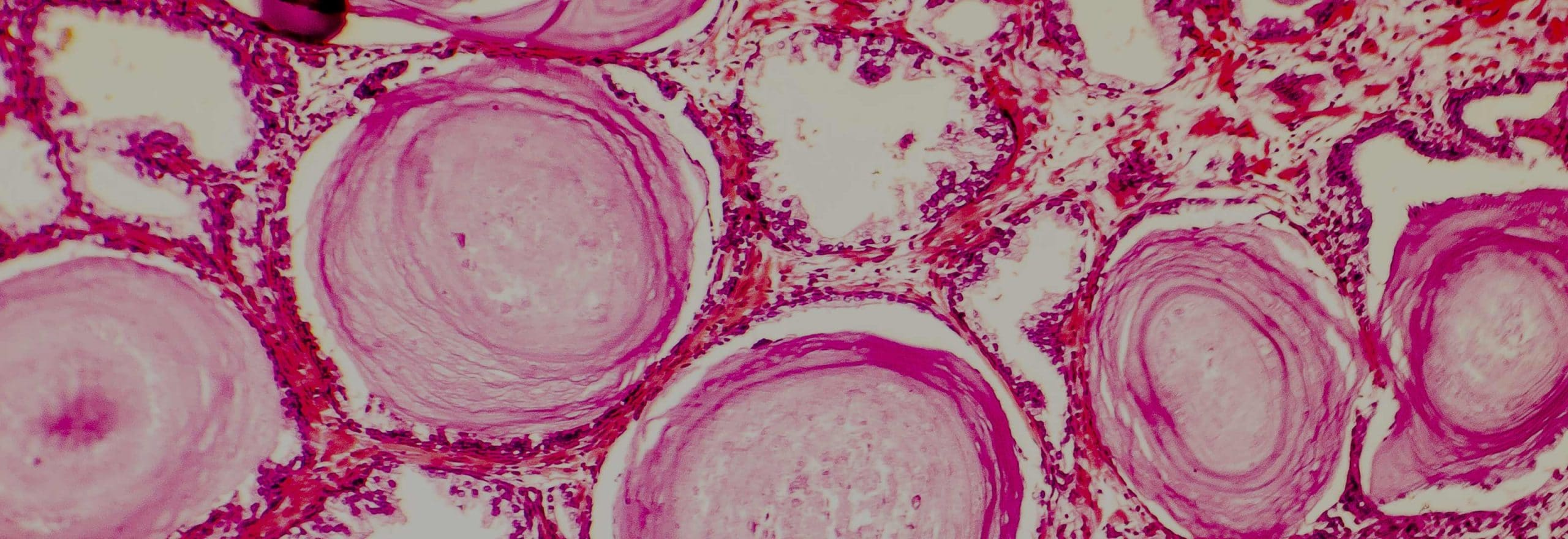 cuidados despues de biopsia de prostata