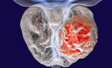 calcificación leve de próstata calcificación leve de próstata