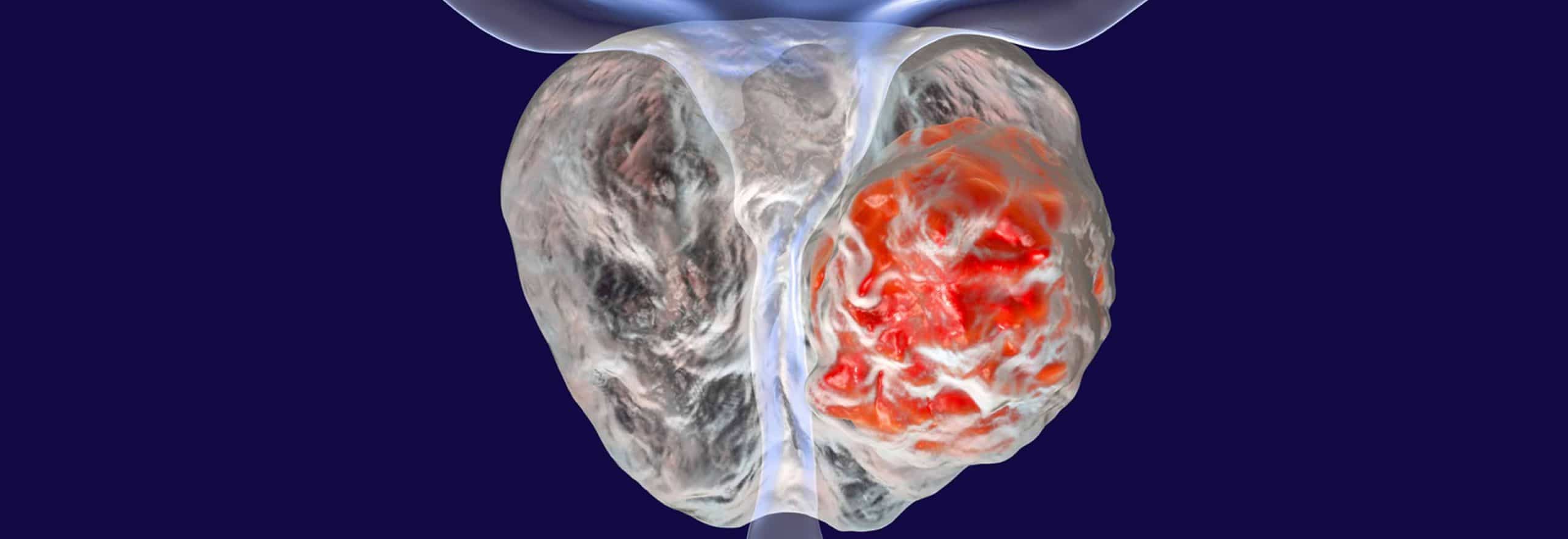 prostata grande cirugia