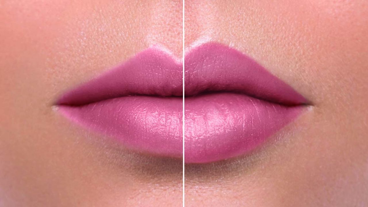 Aumento de labios con acido hialuronico antes y despues de adelgazar