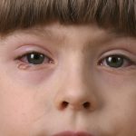 Síntomas de la conjuntivitis vernal en niño