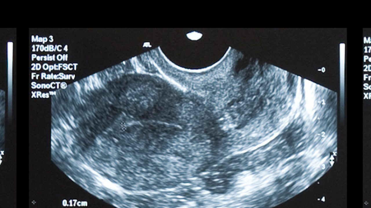 Como se hace una ecografia transvaginal