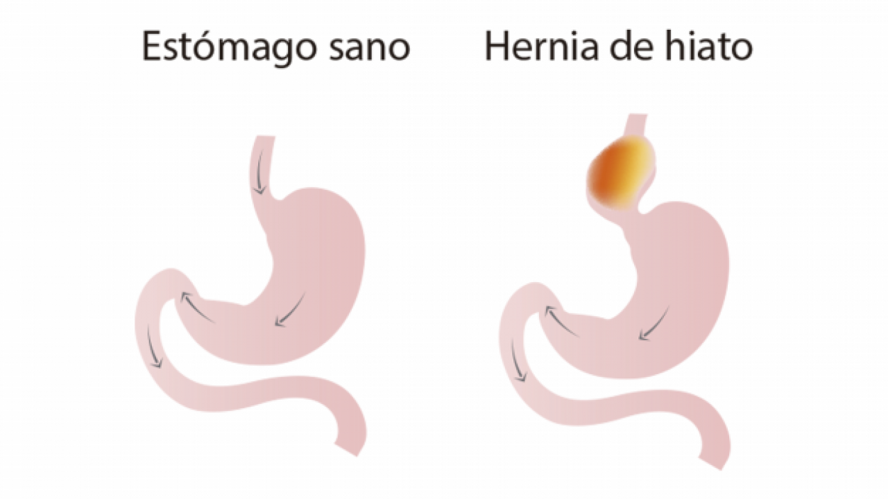 Hernia en el esofago dieta Hernia en el esofago dieta
