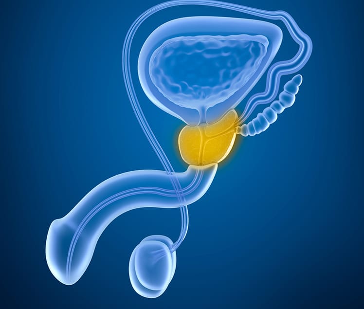 hiperplasia benigna de próstata y sexualidad tratamentul prostatitei cu pătlagină