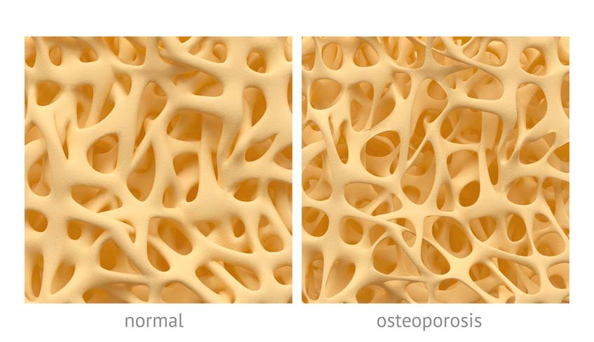 Hueso con osteoporosis