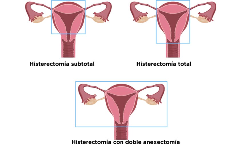 CORSETERIA DREHER - HISTERECTOMÍA Procedimiento de extirpación de