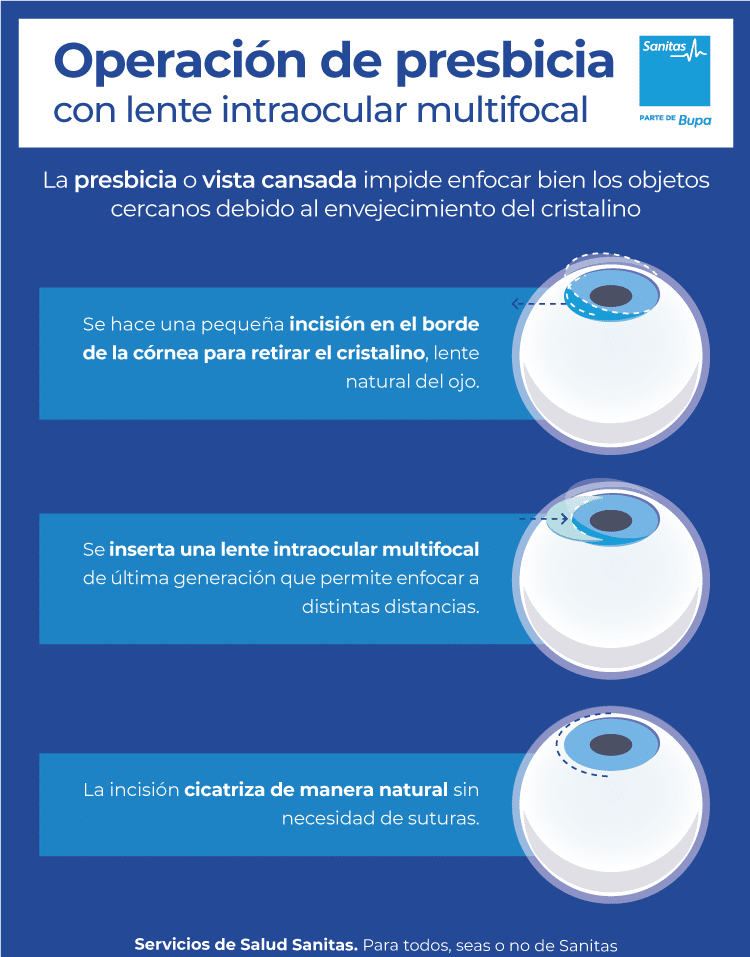 Operación lente intraocular: y testimonios • de salud