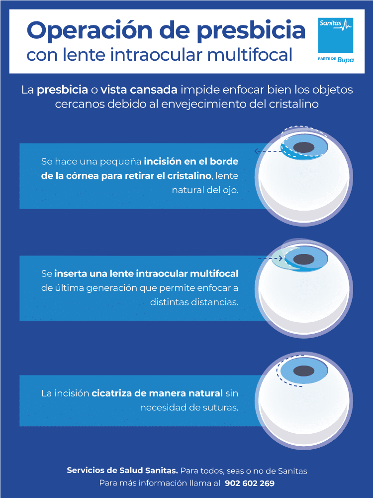 Cómo se opera la presbicia