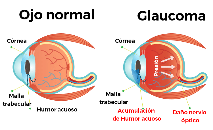 Glaucoma en el ojo