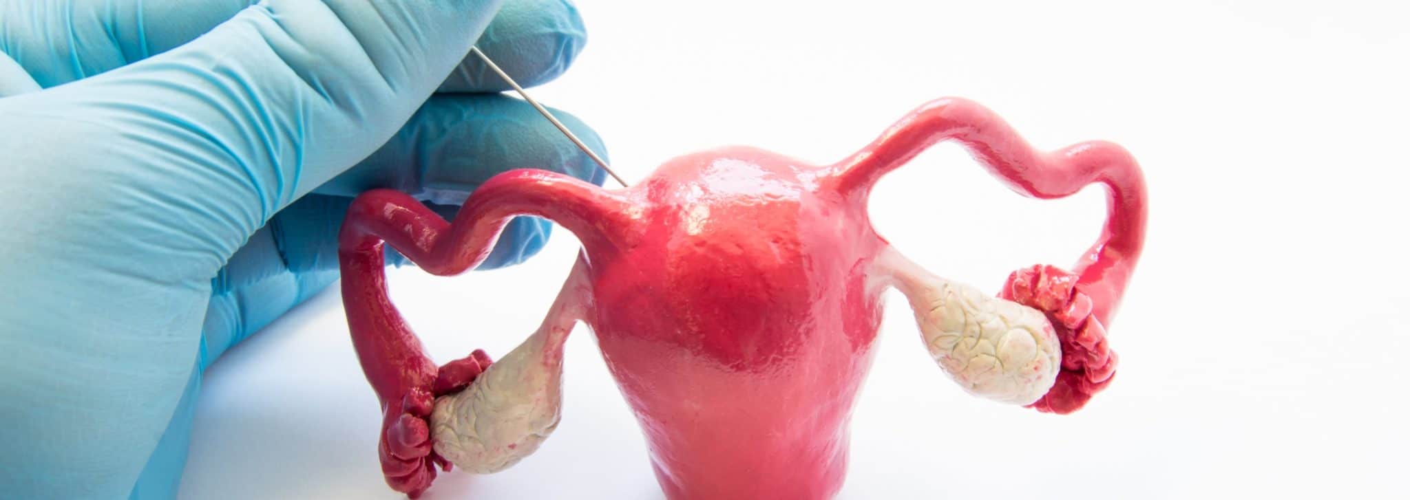 Biopsia Endometrial ¿cómo se realiza? ¿Duele? • Portal de salud Biopsia Endometrial ¿cómo se realiza? ¿Duele? • Portal de salud