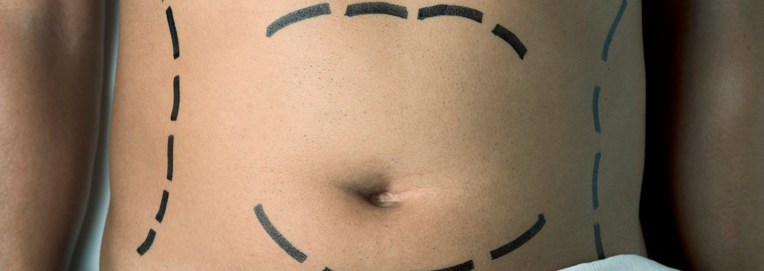 Cicatriz abdominoplastia: Cuidados, tratamientos y consejos • Portal de  salud